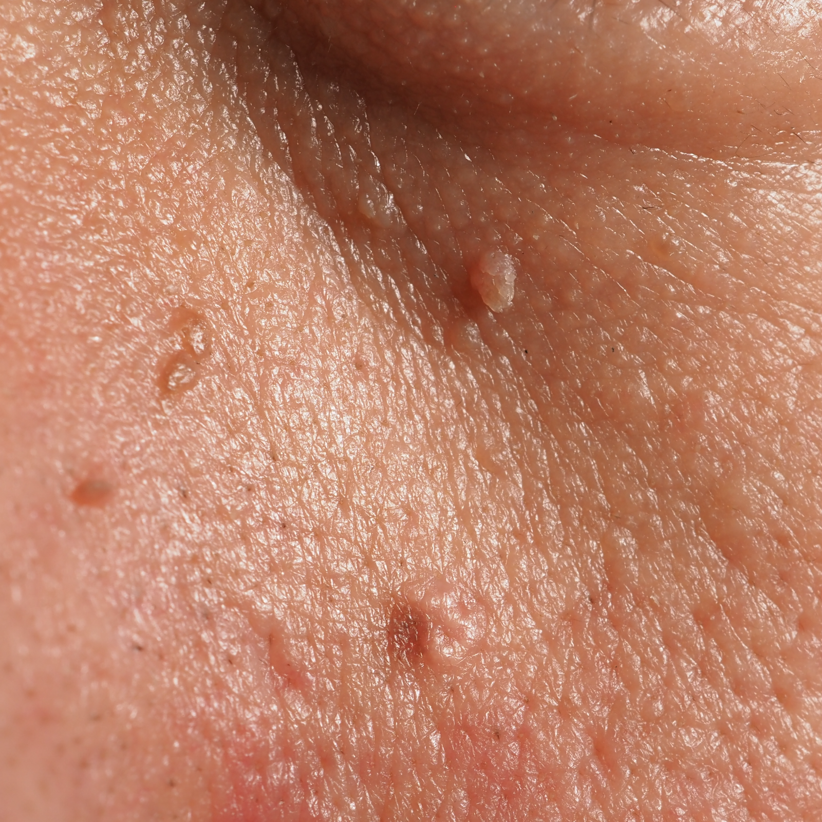 SKIN ANOMALY REMOVAL